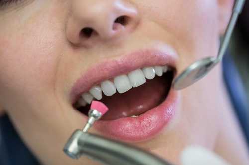 鑲牙後應該怎麽清潔口腔