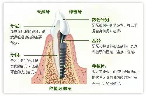 種植牙可以用一輩子嗎？