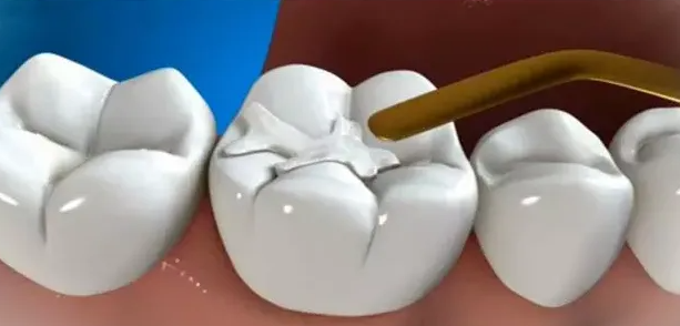 珠海牙科補牙疼嗎？