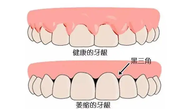 牙齒出現黑三角怎麼辦，我該何去何從？