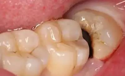 澳門杜牙根—為啥牙齒表面只有一個小洞卻需要做根管治療