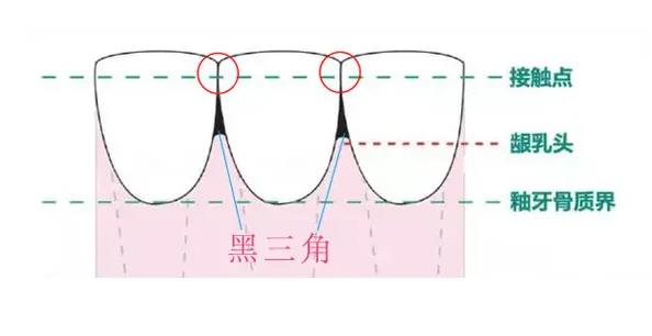 澳門牙醫，牙齒黑三角可以自愈咩？