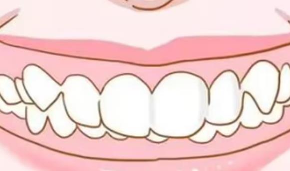 澳門箍牙介紹，牙齒矯正都需要邊些步驟