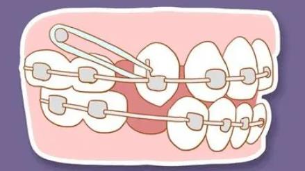 牙齒矯正有必要咩？澳門cooly牙