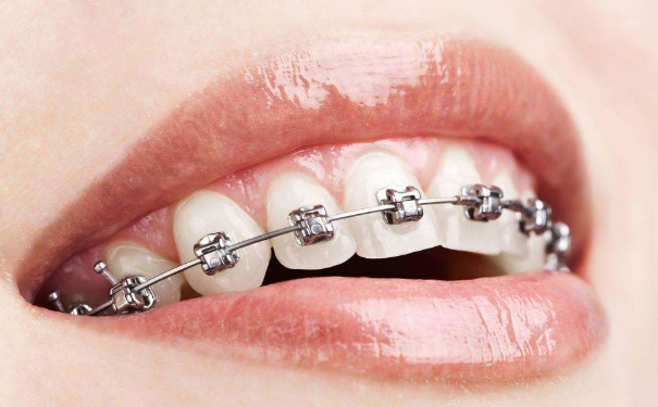 箍牙都有邊些種類，哪種比較好-隱形牙套好嗎？