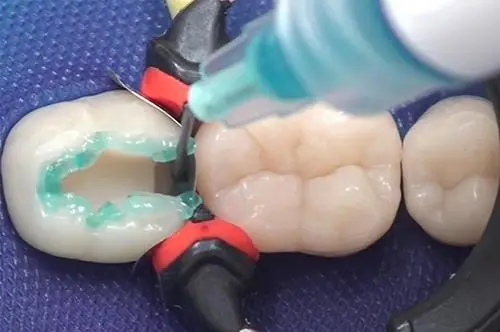 嵌體與補牙有咩區別？不同種類的嵌體都有什麼特點？