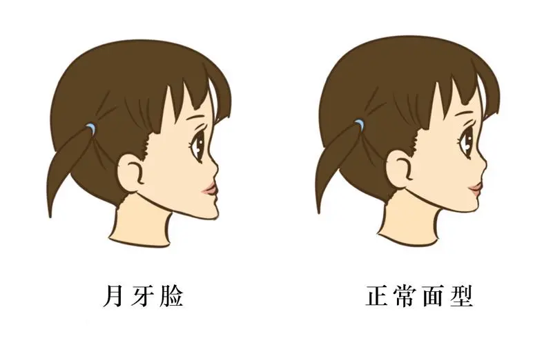 兒童地包天的最佳治療時間