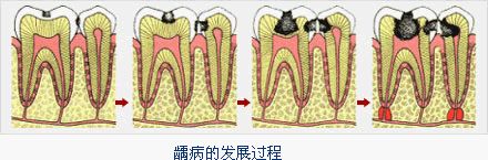 訓覺前唔刷牙，危害特別大！