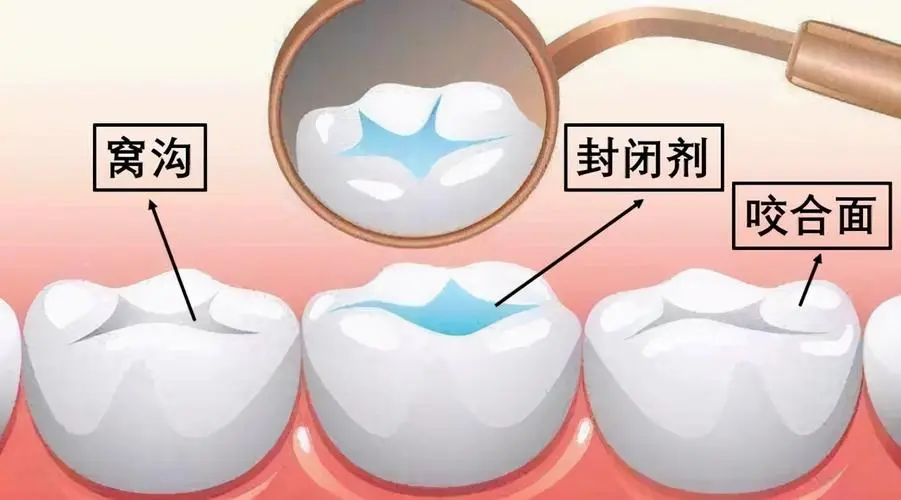 做窩溝封閉痛苦嗎，價位多少？做爸媽的應該提前知道這些