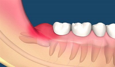 牙龈出現白膿包，你以爲只是發炎嗎？