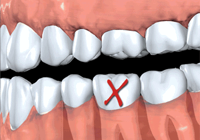 缺牙好耐腫可以種牙嗎？點解要植骨？種植體要點樣選？