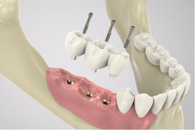 種植牙分為邊啲步驟呀？整個過程需要幾耐呢？