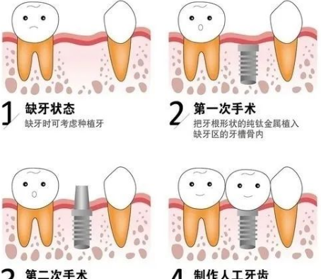 咩啲情況先啱做植牙嘅手術呢？植牙你應該了解邊啲情況