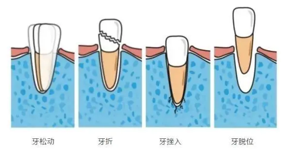 牙外傷，牙齒意外受傷掉了應該點算好？？？