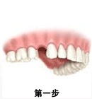 種植牙全過程介紹，詳細易懂，缺牙的長者都需要了解下
