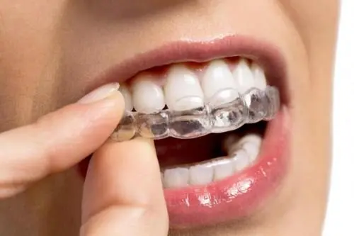 呢4類人牙齒矯正，臉型變化最大！澳門箍牙推薦