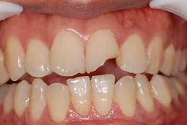 牙齒意外折斷應該怎麼辦？