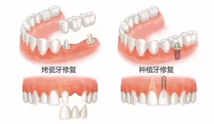 矯正一定要拔牙？拔牙矯正有可替代方法嗎？