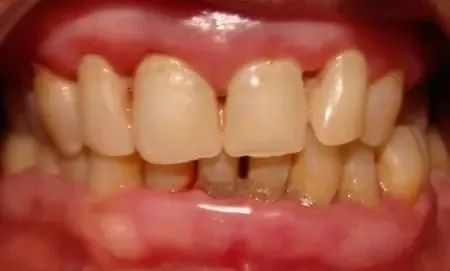 牙齒變長牙縫變寬...注意！你的牙齦正在萎縮！