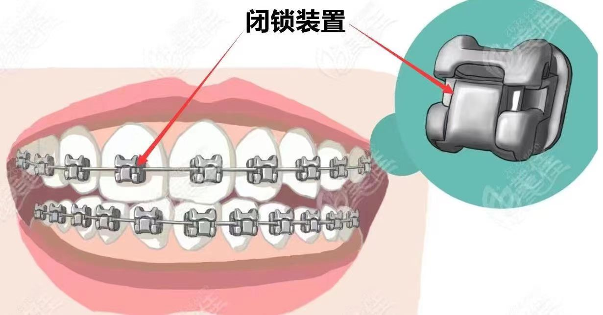 珠海箍牙價錢2024