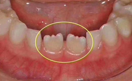 爲什麼孩子換牙期居然變成鋸齒牙？