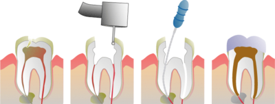 400px-Root_Canal_Illustration_Molar