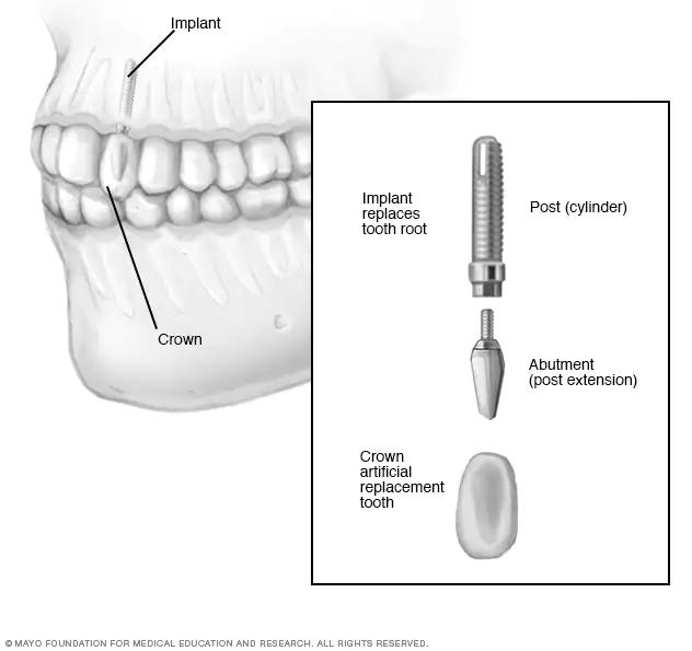 my00084_im00017_de7_dentalimplantthu_jpg