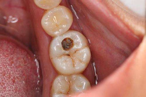 孩子兩歲多牙根腐蝕是什麼原因？會不會以後就不長牙齒了？