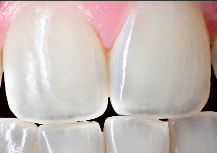是什麼，讓人體最堅硬的牙釉質也會脫落？