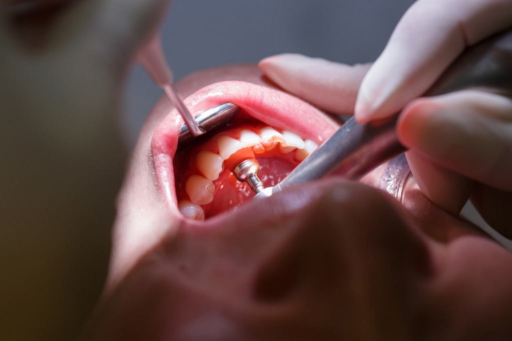 牙齦出現膿包，什麼情況？