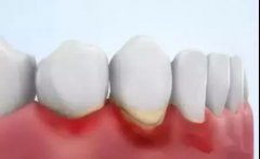 牙周炎形成原因有邊D？