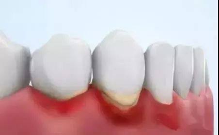牙周炎形成原因