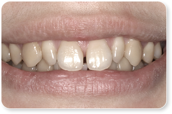 珠海牙齒美白,大陸牙齒美白