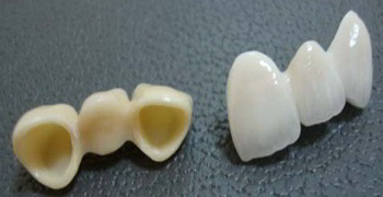 牙冠種類,牙套類型