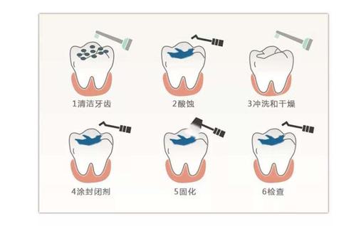 窩溝封閉條件