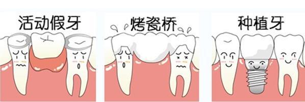 缺牙修復方式