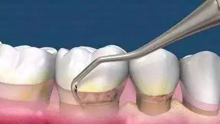 珠海牙周炎治療,大陸牙周治療