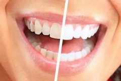 牙齒為何那麼黃，如何變白？