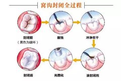 齒從針眼大的洞到拔除，步步驚心！