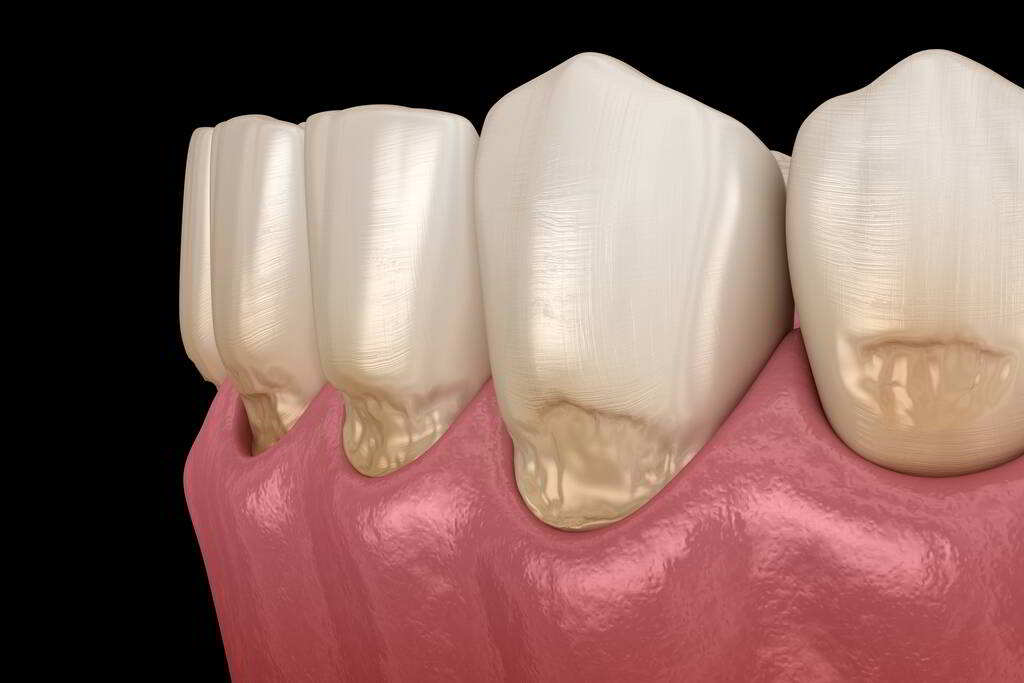牙齦退縮原因,牙齦下降處理方式