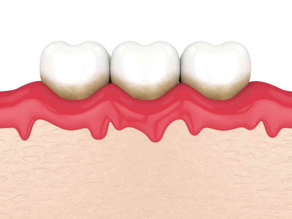 牙齦腫痛原因,牙齒出血原因