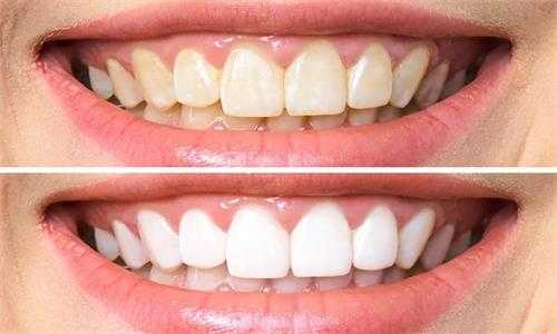 何謂牙本質過敏