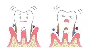 牙周疾病，牙齒鬆動